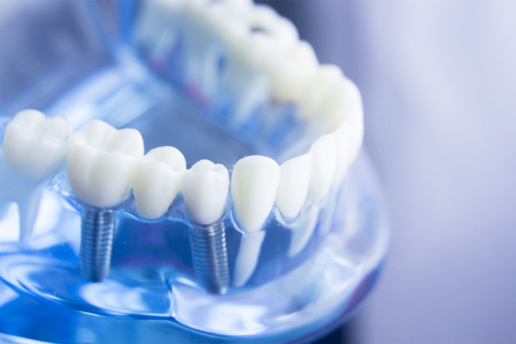 Implant dentaire Marseille - Cabinet dentaire Drs Damiani et Richelme - Dentiste Marseille