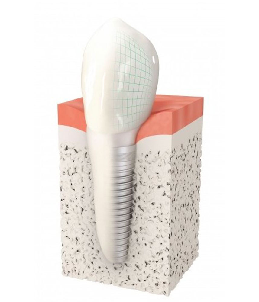 Implant dentaire - Cabinet dentaire Drs Damiani et Richelme - Dentiste Marseille